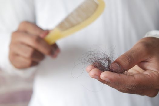 telogen effluvium vs androgenetic alopecia - Androgenetic alopecia: patterned thinning over time