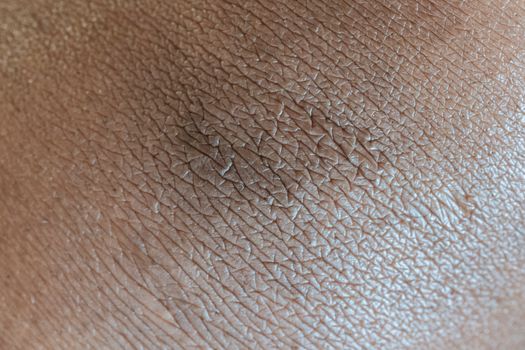 how to tell dry skin vs eczema vs irritation - When to get medical help (and why)