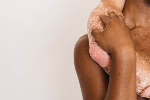 uneven pigmentation troubleshooting dark spots causes - Uneven pigmentation and dark spots: what you’re really seeing